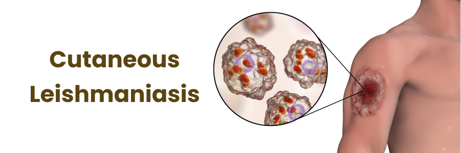 cutaneous leishmaniasis