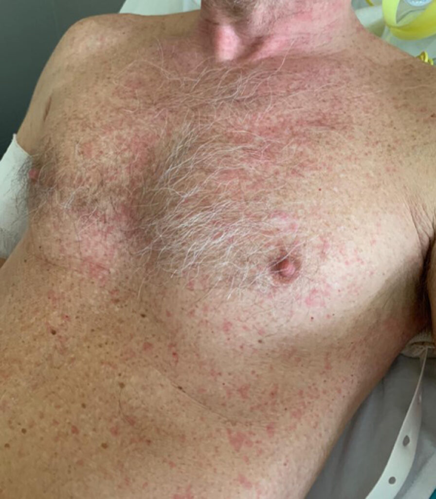 cutaneous listeriosis