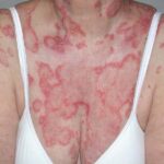 cutaneous lupus erythematosus