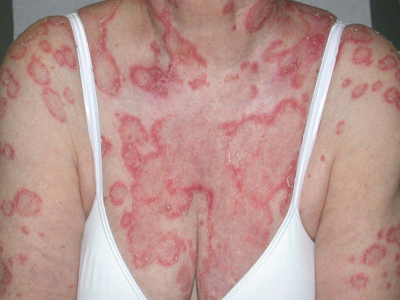 cutaneous lupus erythematosus