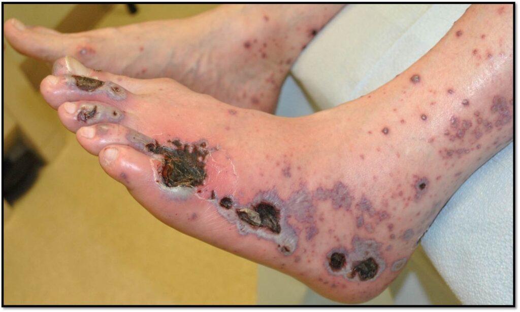 Cutaneous vasculitis