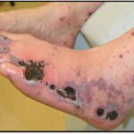 Cutaneous vasculitis