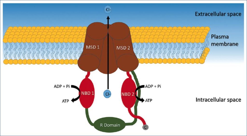 cystic fibrosis with heterozygous f508del mutation in cftr gene