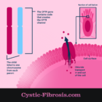 cystic fibrosis with responsive cftr mutation