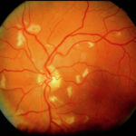 cytomegalovirus retinitis