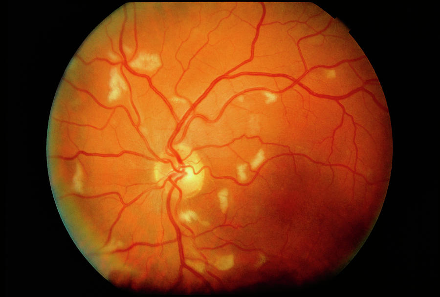 cytomegalovirus retinitis