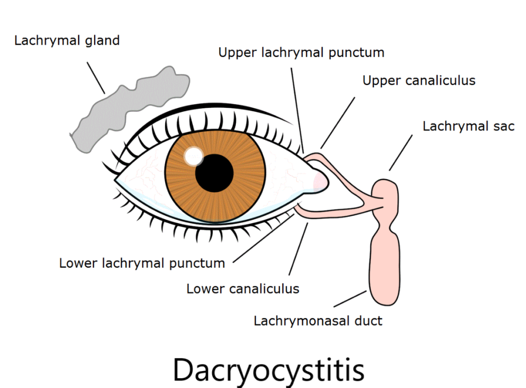 dacryocystitis