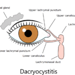 dacryocystitis