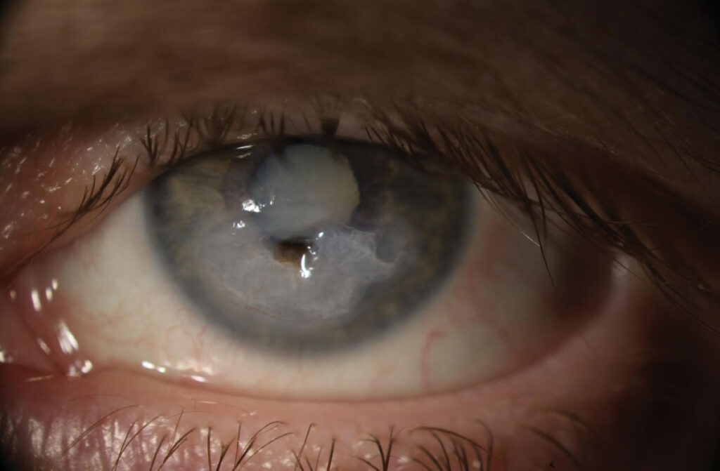 decreased corneal sensitivity