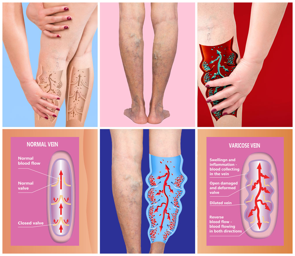 deep vein thrombosis with pulmonary embolism