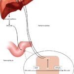 deficiency of bile acids in bile acid synthesis disorder