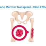 delay or failure of allogenic bone marrow transplant