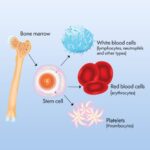 delay or failure of autologous bone marrow transplant