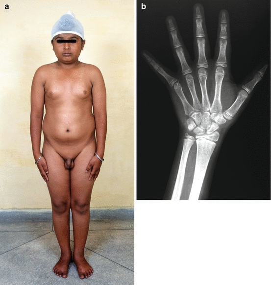 delayed male puberty