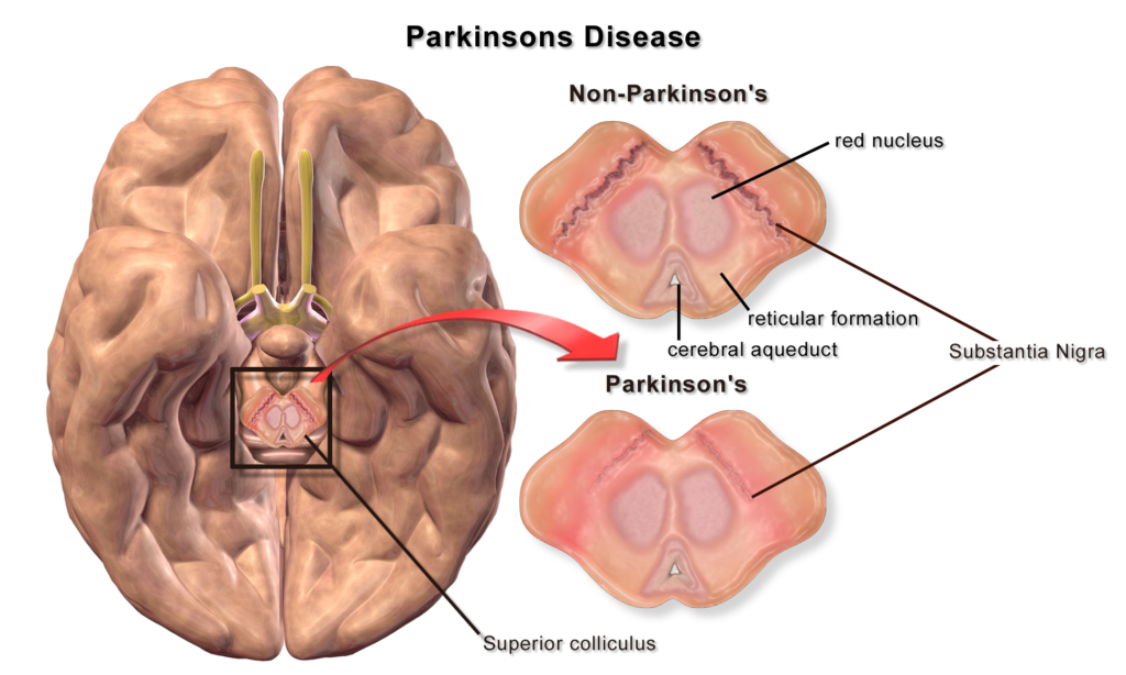 dementia associated with parkinson's disease