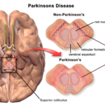 dementia associated with parkinson's disease