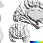 depression associated with bipolar disorder