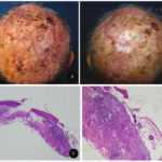 dermatosis of the scalp