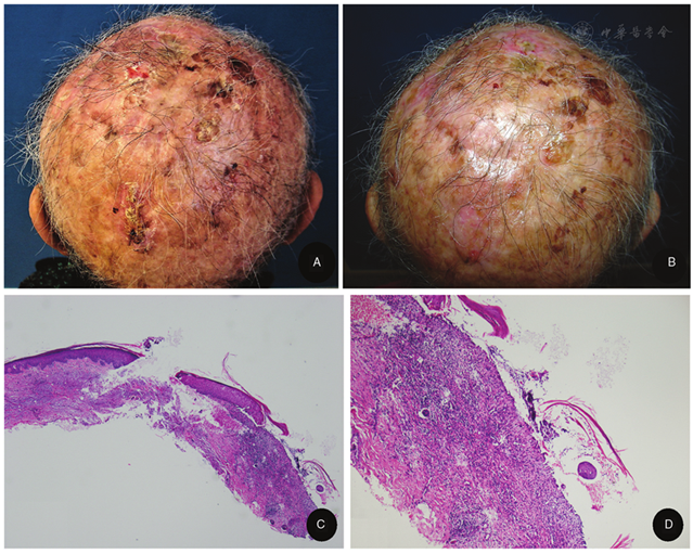 dermatosis of the scalp