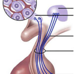 diabetes insipidus