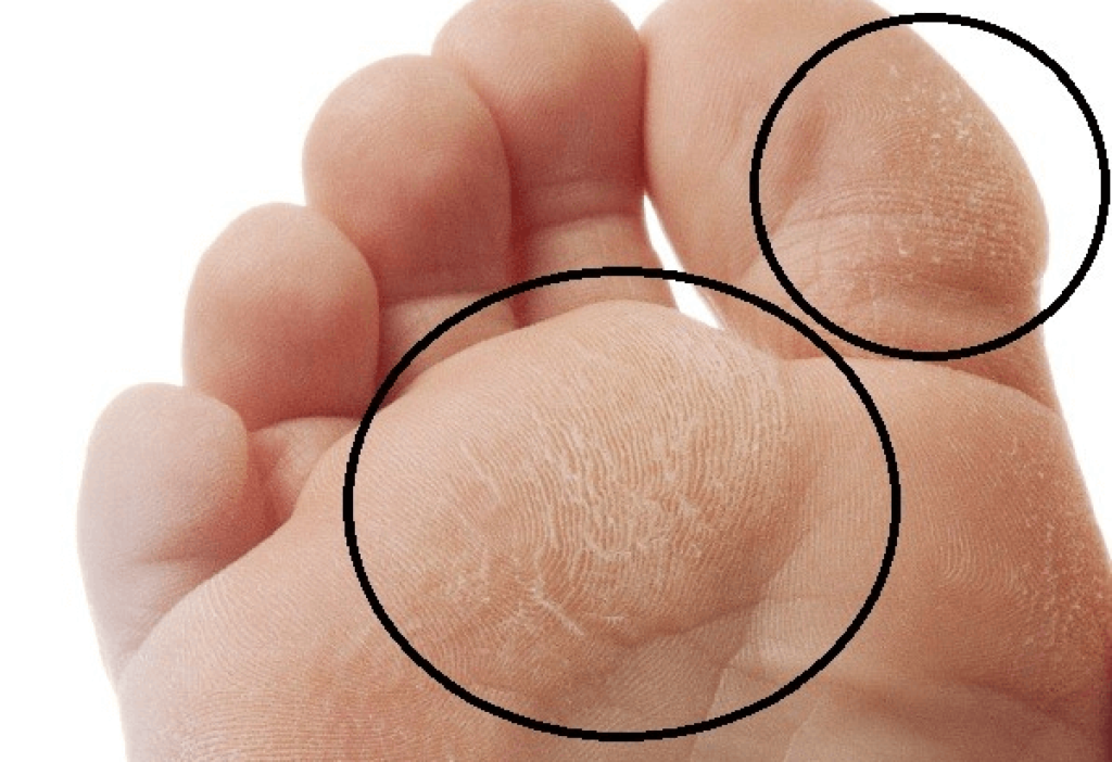 diabetic foot infection