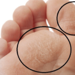 diabetic foot infection