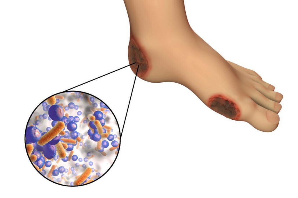 diabetic foot infection due to gram-positive bacteria