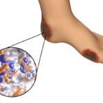 diabetic foot infection due to gram-positive bacteria