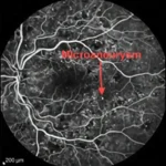 diabetic macular edema