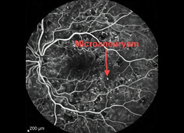 diabetic macular edema