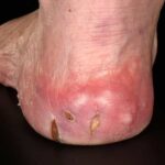 diabetic neuropathic ulcer of lower extremity