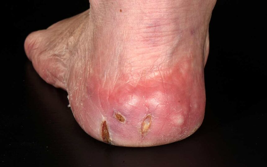 diabetic neuropathic ulcer of lower extremity