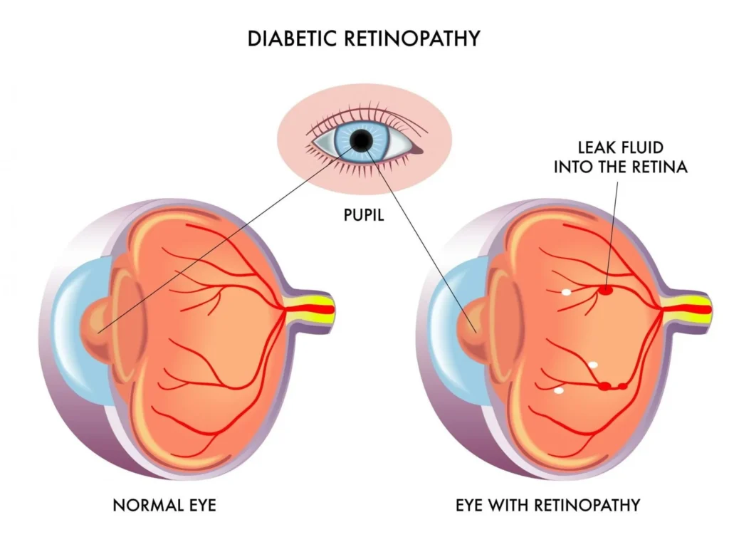 diabetic retinopathy