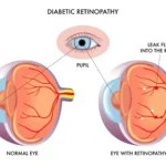 diabetic retinopathy