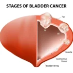 diagnostic cystoscopy aid for bladder cancer detection