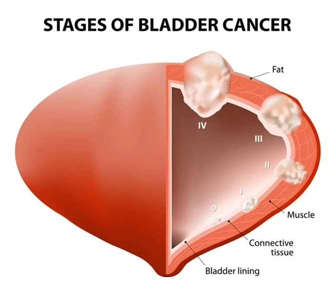 diagnostic cystoscopy aid for bladder cancer detection