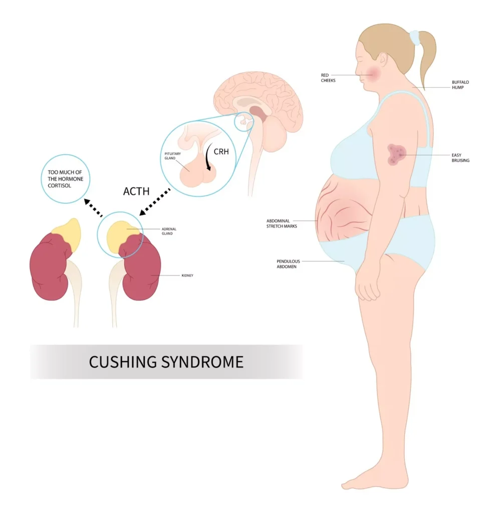 diagnostic test for cushing's syndrome