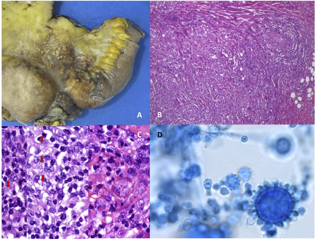 diagnostic test for histoplasma capsulatum exposure