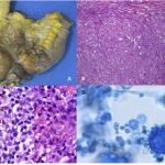 diagnostic test for histoplasma capsulatum exposure