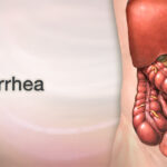 diarrhea