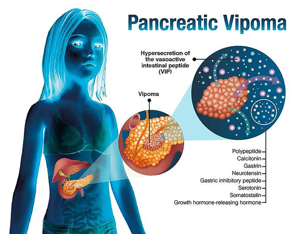 diarrhea associated with vasoactive intestinal peptide (vip)-secreting tumor