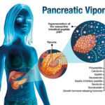 diarrhea associated with vasoactive intestinal peptide (vip)-secreting tumor