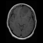 diffuse astrocytoma