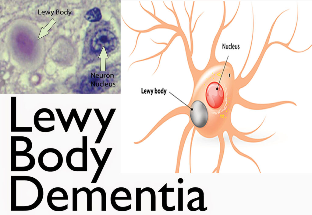 diffuse lewy body disease