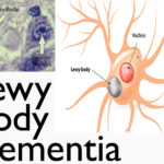 diffuse lewy body disease