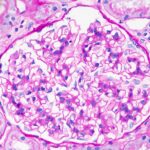 diffuse proliferative lupus nephritis