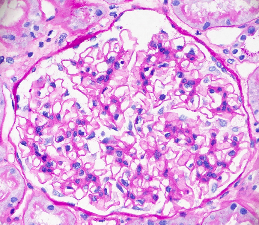 diffuse proliferative lupus nephritis