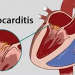 diphtheroid prosthetic heart valve endocarditis