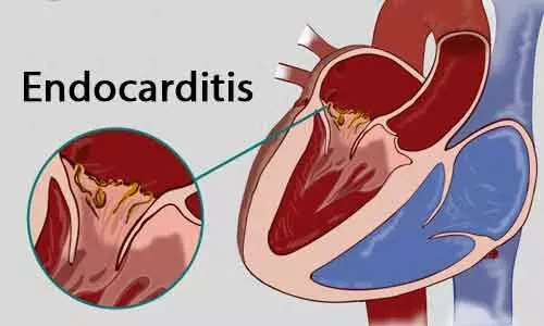 diphtheroid prosthetic heart valve endocarditis