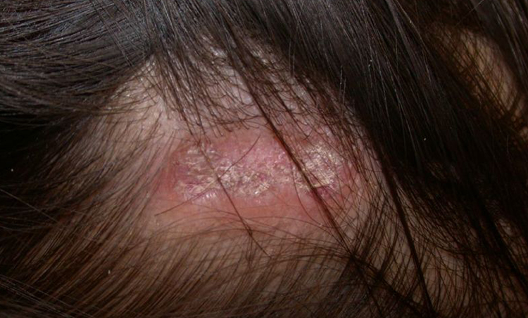 discoid lupus erythematosus